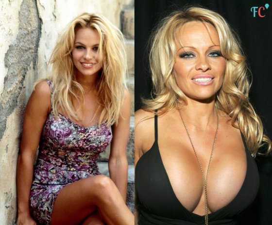 Pamela Anderson-ი უწინ და ეხლა