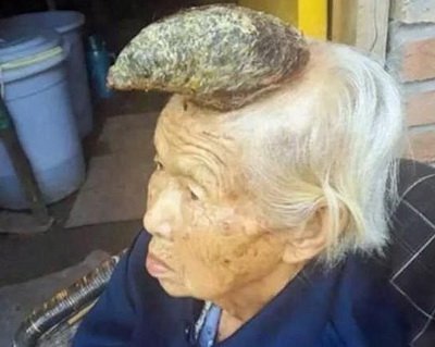 87 წლის ჩინელ მოხუცს თავზე 13 სანტიმეტრიანი რქა ამოუვიდა