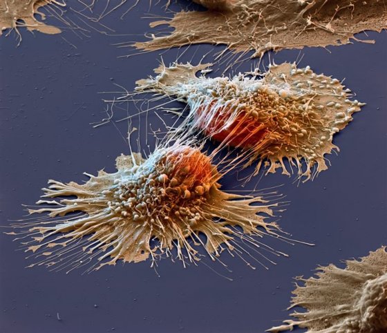 კიბოს  უჯრედები მიკროსკოპის  ქვეშ