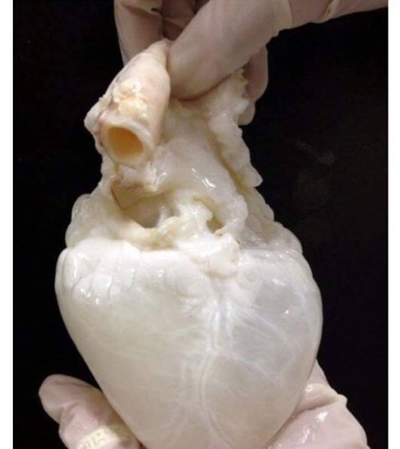 ასე გამოიყურება სისხლგამოცლილი გული.