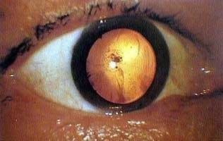 იმ ადამიანის თვალის კაკალი, რომელიც ჰიროსიმაში ატომური ბომბის აფეთქებას ემსხვერპლა, 1945 წელი